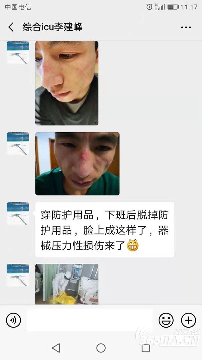 心疼!连线安徽援鄂护士李建峰 脸上被防护用具压出“天使印记”(组图)-