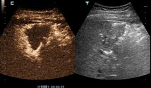 H:\2019肝癌消融课件\3＜5cm人工腹水\造影后残留.JPG